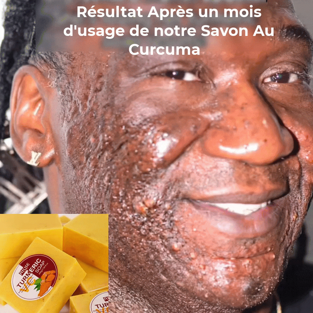 AILKE® Savon Curcuma Bio Anti-Acné
